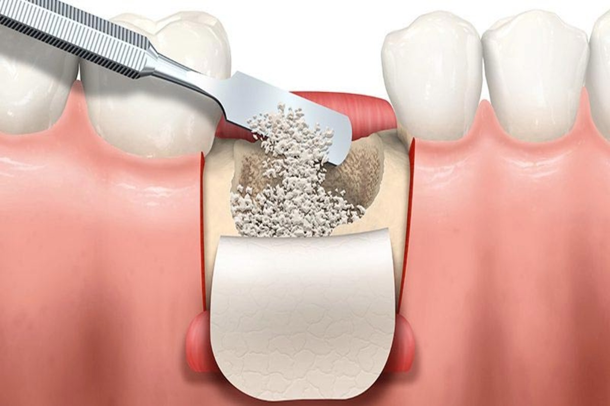 Impianti dentali senza osso in Albania